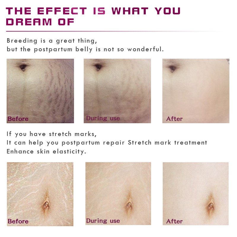 Stretch Marks Remover Essential Oil Skin Care Treatment Cream For Stretch Mark Removal Maternity Slackline For Pregnant Oils