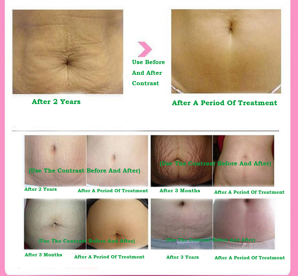 Stretch Marks Remover Essential Oil Skin Care Treatment Cream For Stretch Mark Removal Maternity Slackline For Pregnant Oils