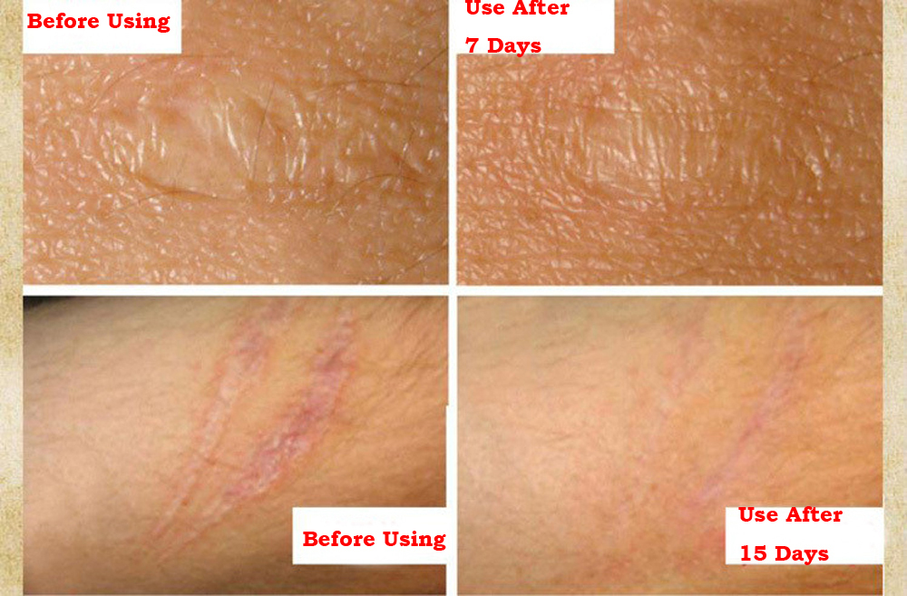 Stretch Marks Remover Essential Oil Skin Care Treatment Cream For Stretch Mark Removal Maternity Slackline For Pregnant Oils