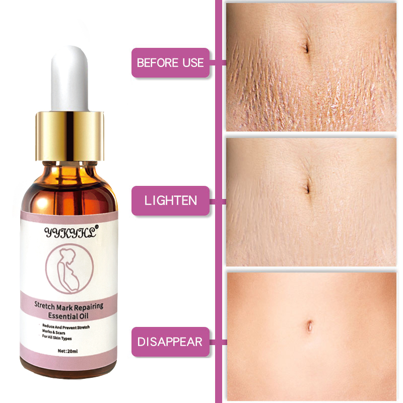Stretch Marks Remover Essential Oil Skin Care Treatment Cream For Stretch Mark Removal Maternity Slackline For Pregnant Oils