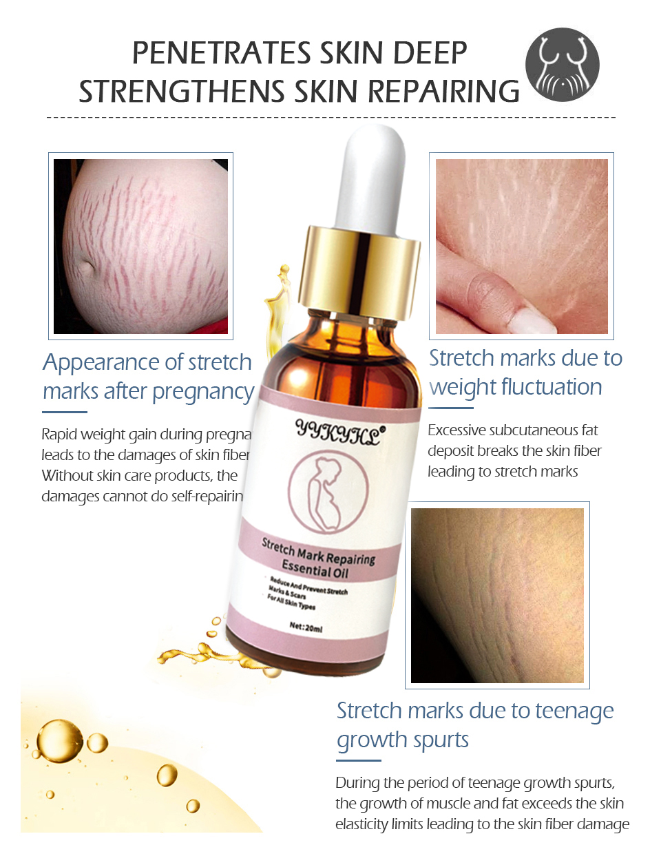 Stretch Marks Remover Essential Oil Skin Care Treatment Cream For Stretch Mark Removal Maternity Slackline For Pregnant Oils
